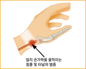 엄지 손가락을 움직이는 힘줄 및 터널의 염증