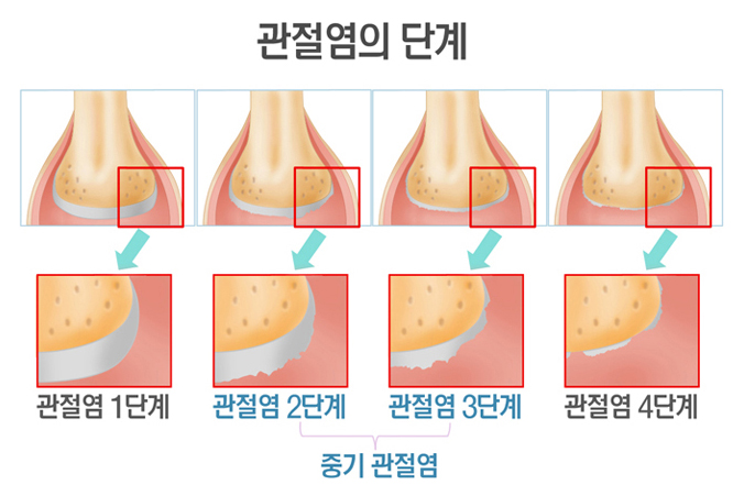 관절염의 단계 - 관절염의 1단계, 관절염의 2단계(중기 관절염), 관절염의 3단계(중기 관절염), 관절염의 4단계
