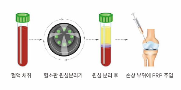 PRP 주사