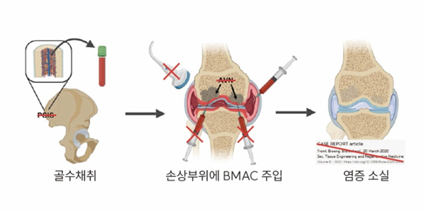 자가줄기세포 BMAC 주사
