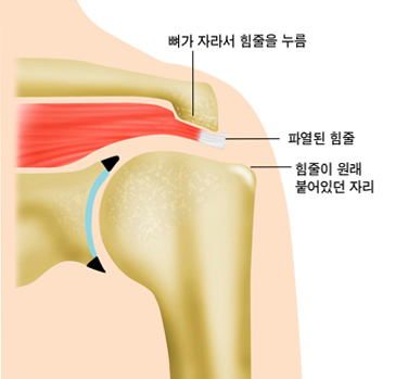 뼈가 자라서 힘줄을 누름, 파열된 힘줄, 힘줄이 원래 붙어있던 자리