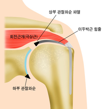 상부 관절와순 파열, 이두박근 힘줄