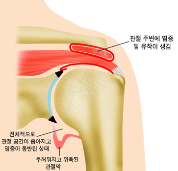 전체적으로 관절 공간이 좁아지고 염증이 동반된 상태, 두꺼워지고 위축된 관절 막, 관절 주변에 염증 및 유착이 생김