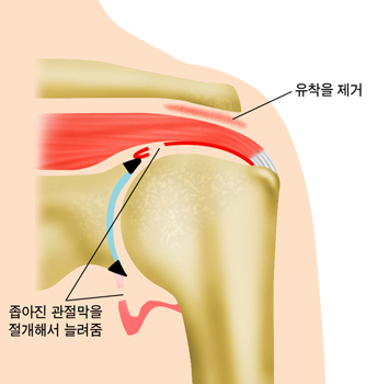 좁아진 관절막을 절개해서 늘려줌, 유착을 제거