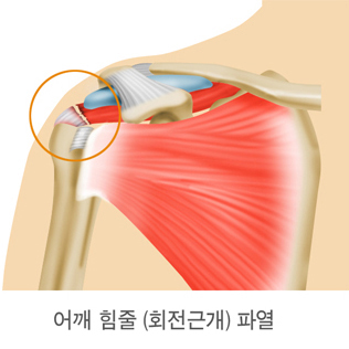 어깨 힘줄 (회전근개) 파열