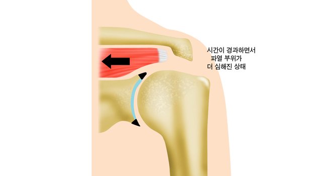 시간이 경과하면서 파열 부위가 더 심해진 상태