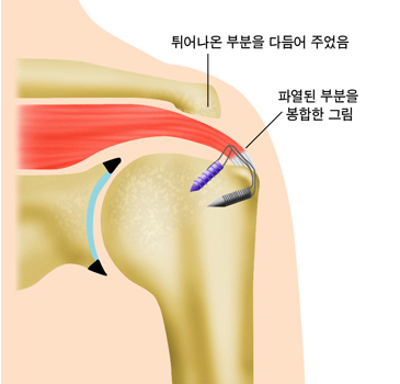 튀어나온 부분을 다듬어 주었음, 파열된 부분을 봉합한 그림