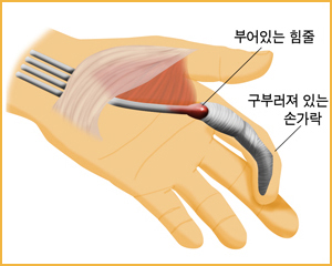 방아쇠수지