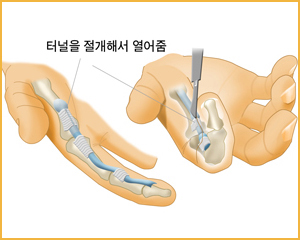 터널을 절개해서 열어줌