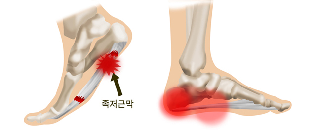 족저근막