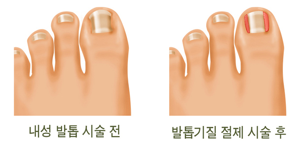 내성 발톱 사진, 발톱기질 절제 시술 후