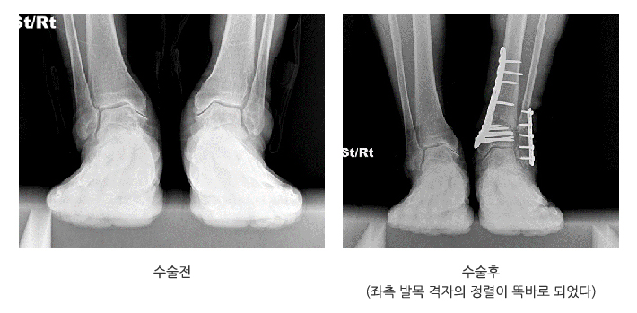 수술전, 수술후(좌측 발목 격자의 정렬이 똑바로 되었다)