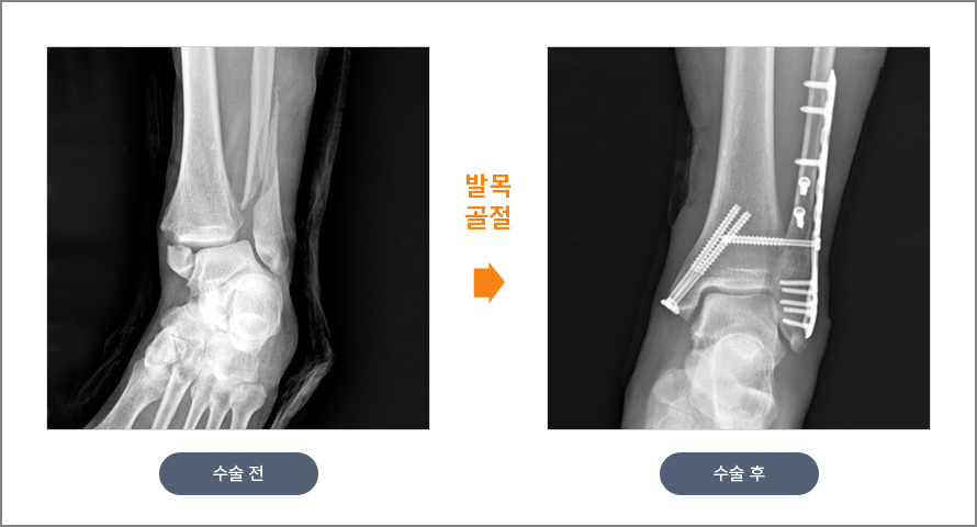 발목 골절 수술 전후