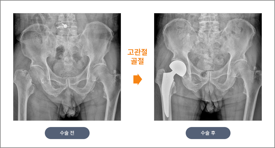 고관절 골절 수술 전후