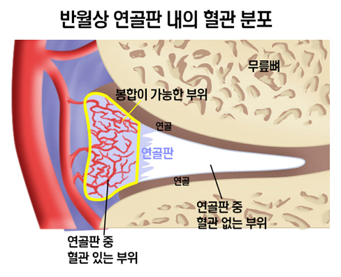 반월상 연골판 내의 혈관 분포 - 무릎뼈, 봉합이 가능한 부위, 연골, 연골판, 연골판 중 혈관 없는 부위, 연골판 중 혈관 있는 부위