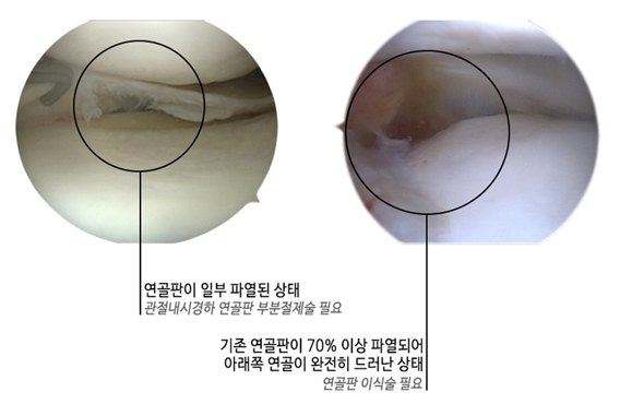 연골판이 일부 파열된 상태(관절내시경하 연골판 부분절제술 필요), 기존 연골판이 70% 이상 파열되어 아래쪽 연골이 완전히 드러난 상태(연골판 이식술 필요)