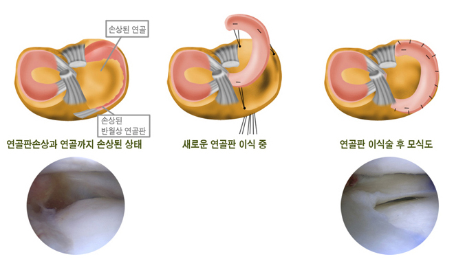 연골판손상과 연골까지 손상된 상태(손상된 연골, 손상된 반월상 연골판), 새로운 연골판 이식 중, 연골판 이식술 후 모식도