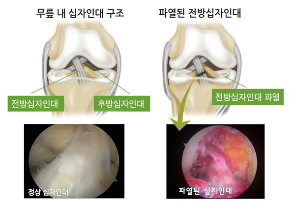 무릎 내 십자인대 구조(전방십자인대, 후방십자인대), 파열된 전방십자인대(전방십자인대 파열)