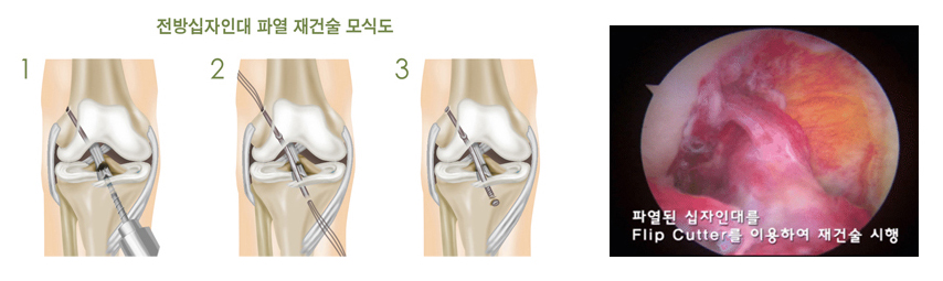 전방십자인대 파열 재건술 모식도, 파열된 십자인대를 Flip Cutter를 이용하여 재건술 시행