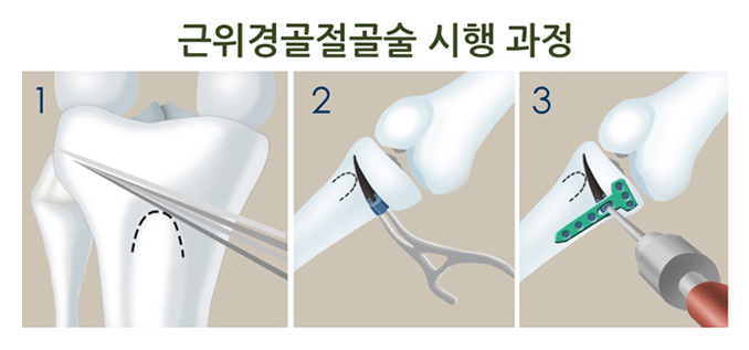 근위경골 절골술 시행 과정