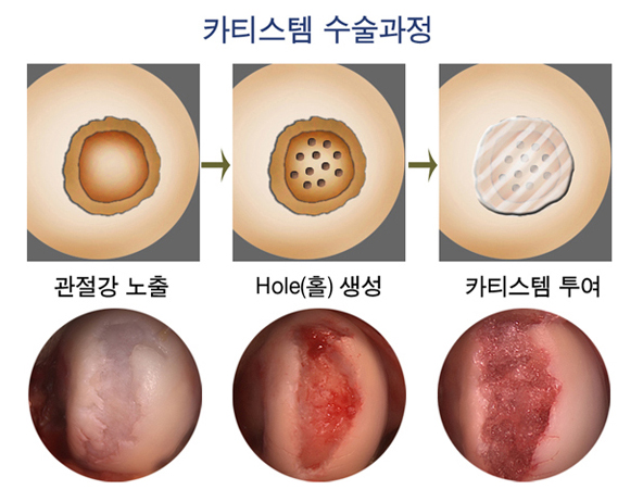 카티스템 수술과정 - 관절강 노출, Hole(홀) 생성, 카티스템 투여