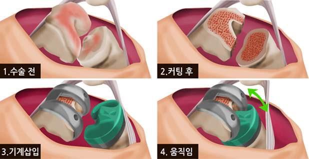 1. 수술 전 2. 커팅 후 3. 기계삽입 4. 움직임