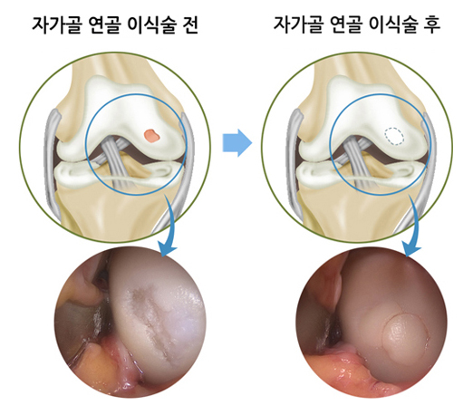 자가골 연골 이식술 전, 자가골 연골 이식술 후