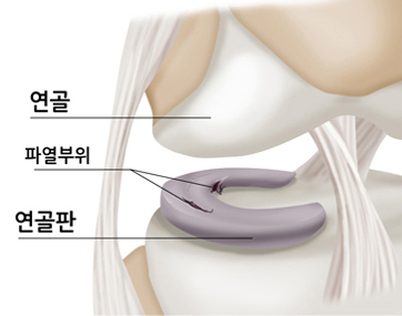 연골, 파열부위, 연골판