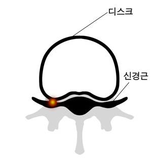 디스크, 신경근