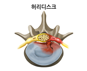 허리디스크