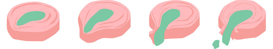 Sequestration, Extrusion, Protrusion, Bulging disc