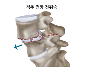 척추전방전위증