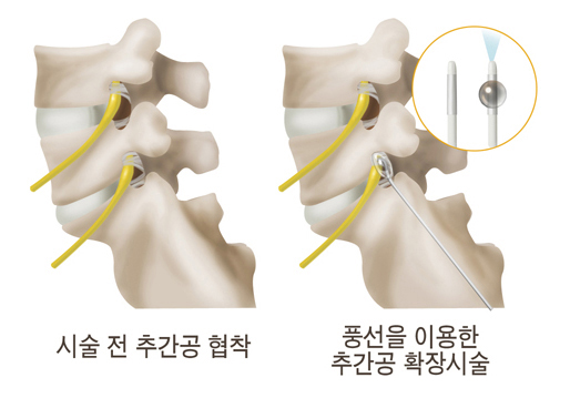 풍선확장술