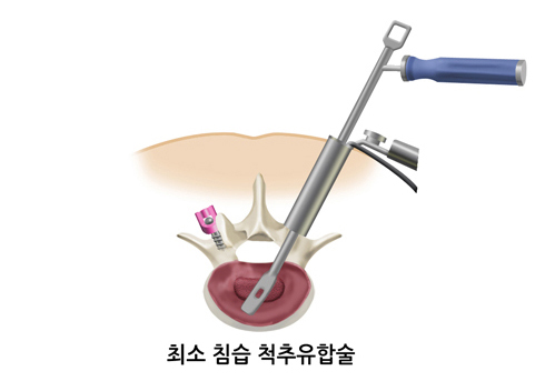 척추유합술