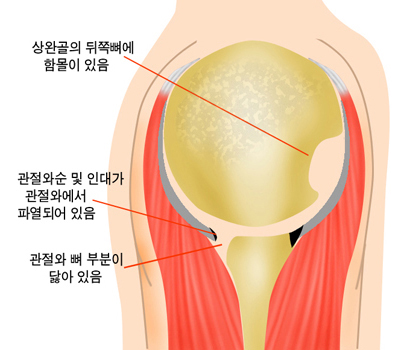 상완골의 뒤쪽뼈에 함몰이 있음, 관절와순 및 인대가 관절와에서 파열되어 있음, 관절와 뼈 부분이 닳아 있음