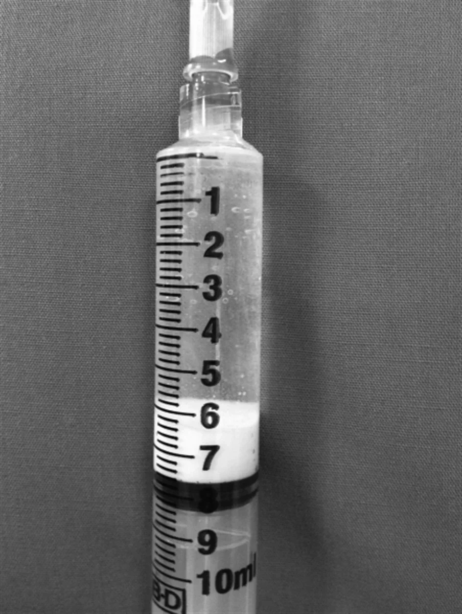 10ml 주사기 안에 흡인해 낸 하얀 석회 침착물이 가라앉아 있는 모습