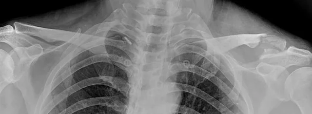 원위 쇄골 골절 수술 전 X-ray