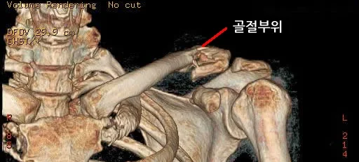 원위 쇄골 골절의 3차원 CT. 골절 부위가 빨간 선으로 표시되어 있다