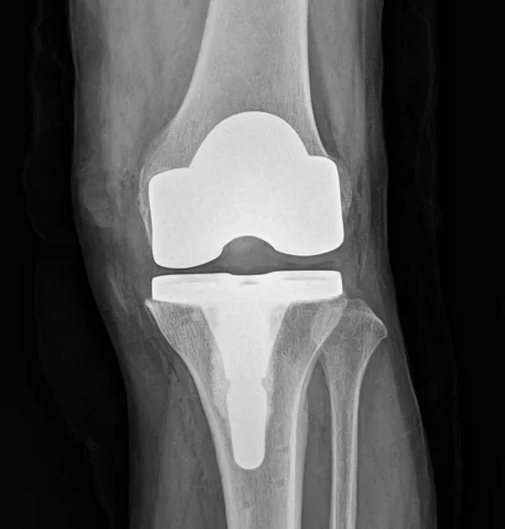 무릎 인공관절 전치환술 후 정면 X-ray. 대퇴골과 경골 끝에 금속 부품이 씌워져 있다