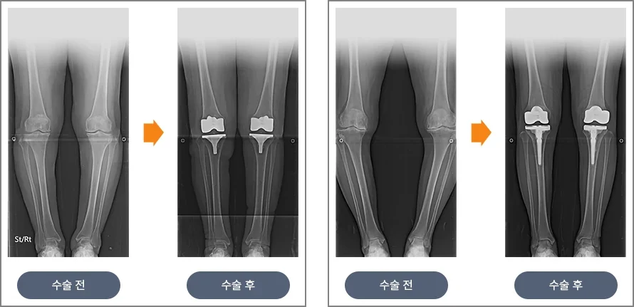 무릎 인공관절 전치환술 전후의 다리 전체 X-ray 두 쌍. 수술 전에는 관절 간격이 좁고 다리가 휘어 있고, 수술 후에는 금속 인공관절이 들어가 다리 축이 곧게 정렬되어 있다