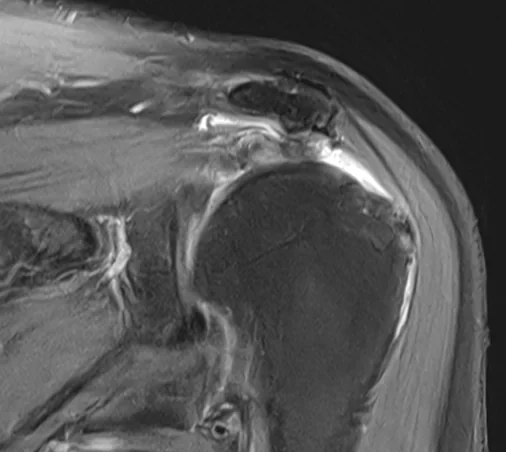 어깨 관상면 MRI. 파열된 회전근개 힘줄이 위팔뼈에서 떨어져 안쪽으로 말려 들어간 모습
