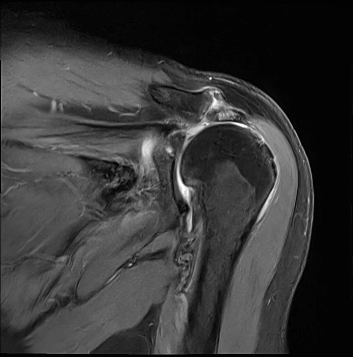 회전근개 파열 관절병증 MRI(관상면). 위팔뼈 머리 위를 덮어야 할 회전근개 힘줄이 보이지 않고, 위팔뼈 머리가 위로 올라붙어 견봉 바로 아래까지 닿아 있다