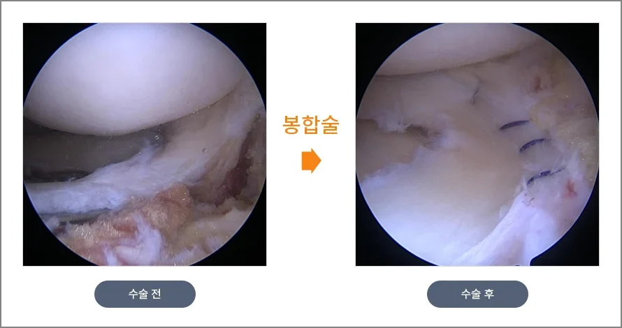 무릎 관절내시경으로 본 반월상 연골 봉합술 전후. 왼쪽은 찢어진 반월상 연골, 오른쪽은 봉합사로 꿰매 붙인 모습
