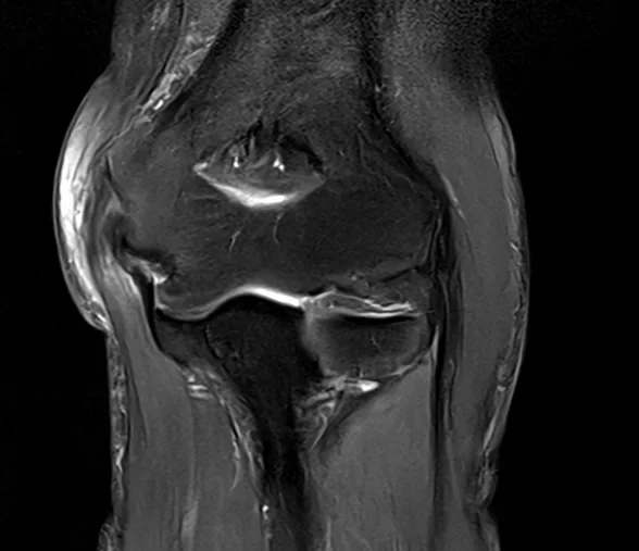 무릎 관절 관상면 MRI 영상