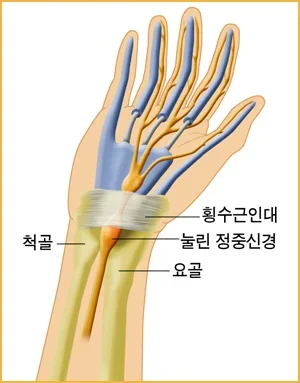 손목터널 속을 지나는 정중신경이 가로손목인대 아래에서 눌려 엄지·검지·중지 쪽으로 저림이 퍼지는 모습을 그린 손목터널증후군 모식도