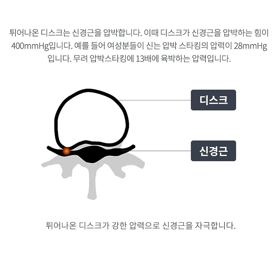 요추 단면 모식도. 뒤로 튀어나온 디스크가 신경근을 누르는 지점이 주황색 점으로 표시되어 있다