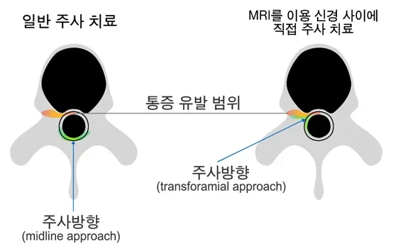 경막외 방식과 추간공 방식 신경주사를 비교한 척추 단면 모식도. 왼쪽은 척추 뒤 가운데로, 오른쪽은 옆쪽 신경 구멍으로 주사가 들어간다