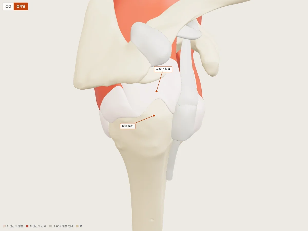 오른쪽 어깨 회전근개 중파열 3D 모델, 극상근 힘줄이 위팔뼈 부착부에서 떨어져 붙어 있던 자리가 드러난 모습