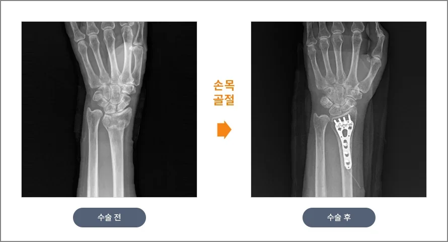 손목 골절 수술 전후 X-ray. 수술 후 요골 끝이 금속판과 나사로 고정되어 원래 모양을 되찾았다