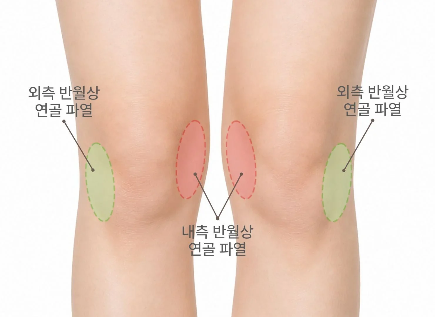 반월상 연골 파열, 수술 안 하면 어떻게 될까요?